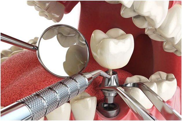 Dental Implant