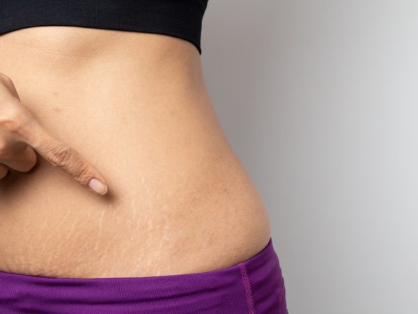 What Are Natural Home Remedies Used to Treat Stretch Marks?