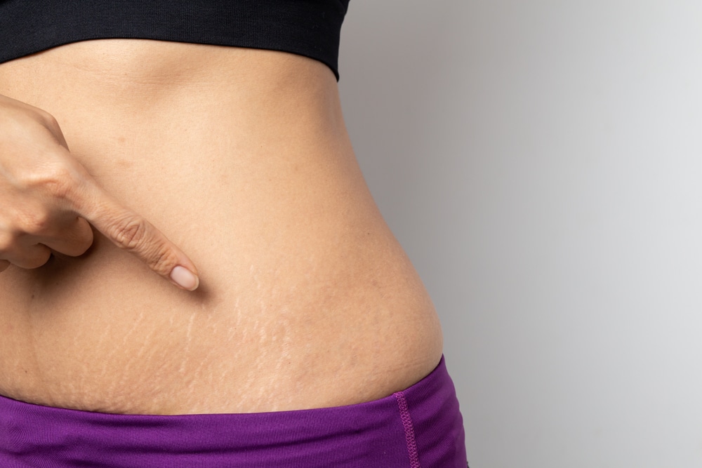 What Are Natural Home Remedies Used to Treat Stretch Marks?